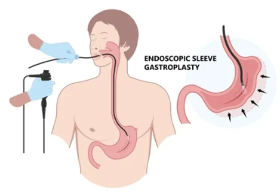 Imagen de procedimiento de manga endoscópica con endoscopio