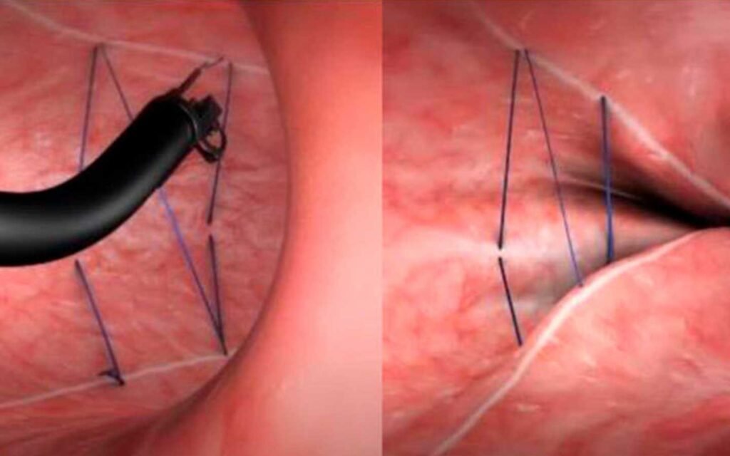 sutura mang gastrica endoscopica