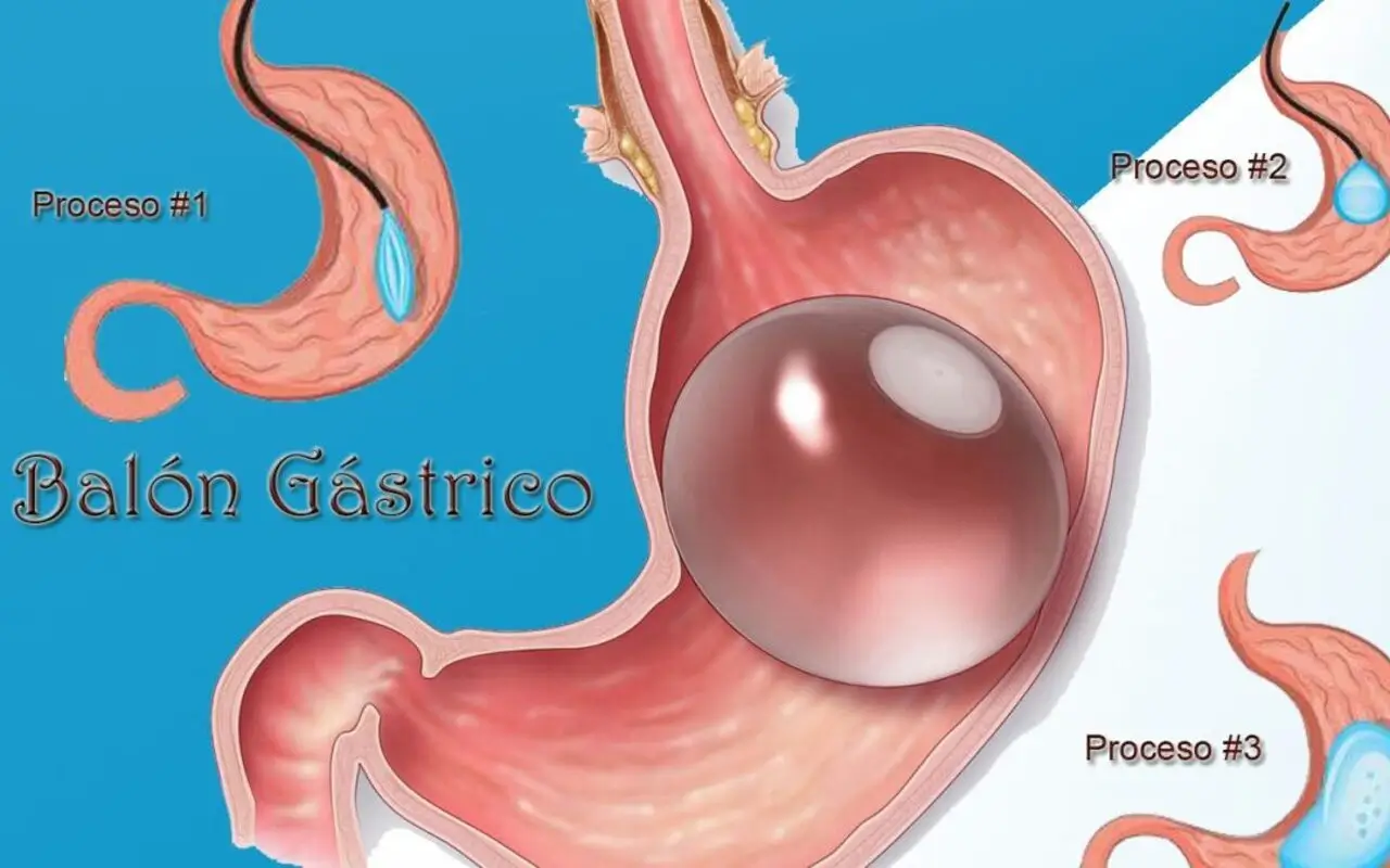 Imagen de balón intragástrico inflado dentro del estómago – balón gástrico