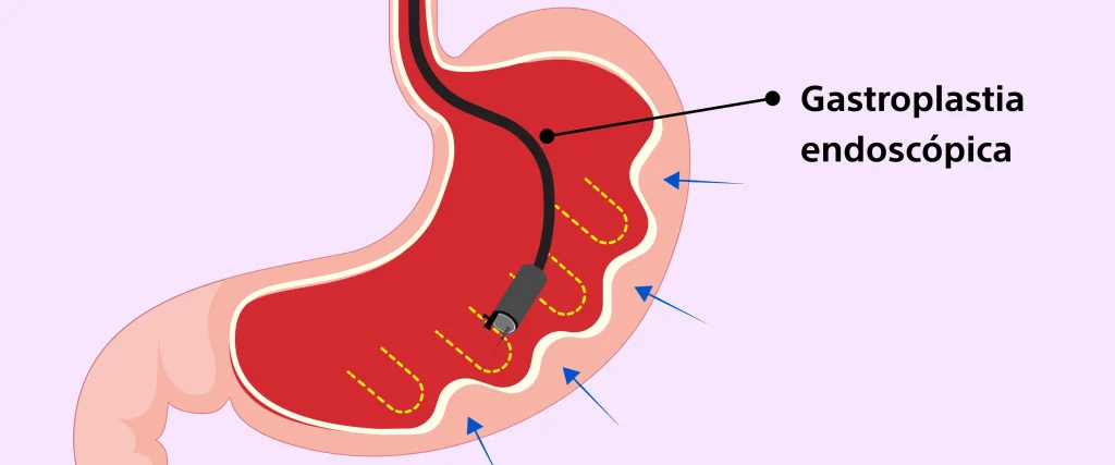 Gastroplastia-endoscopica clinica manga endoscopica