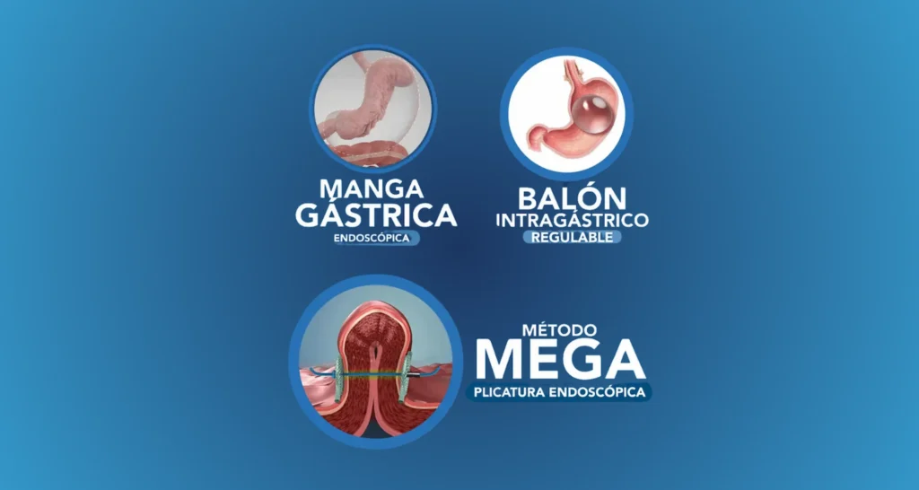 manga gástrica endoscópica - manga gastrica endoscopica